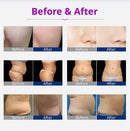 Máquina de adelgazamiento corporal con cavitación láser liposucción y radiofrecuencia Kim 8 - K10 6 en 1