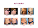 Shape Tactics 5-in-1 Cryolipolysis Vacuum Radio Frequency Cooling System