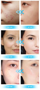 Shape Tactics Advanced 14-in-1 Hydro Dermabrasion with PDT Light Therapy
