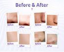 Shape Tactics Diamond Microdermabrasion Machine for Blackhead Removal